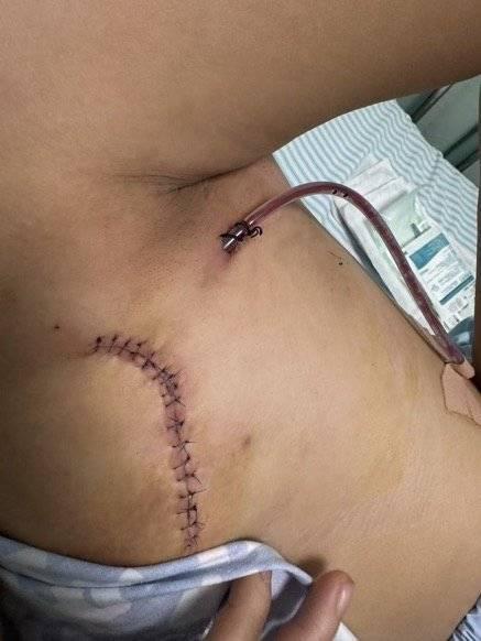 加拿大曾把胸隆炸的网红在泰国坠楼身亡，生前坦言对整容感到后悔